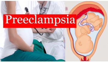 Фото: Преэклампсия