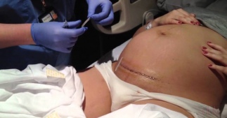 Гестоз как показание к кесареву