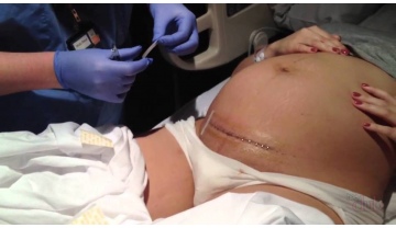 Фото: Гестоз и кесарево